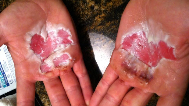 Thermal Hand Injury