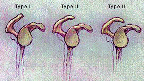 Various Acromion Types