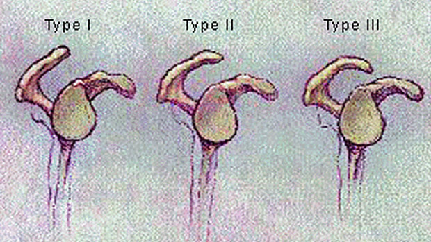 types of acromions